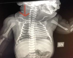 frattura clavicola neonato